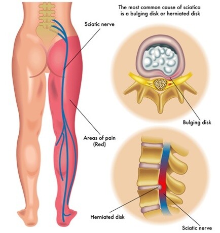 sciatica herniated disc