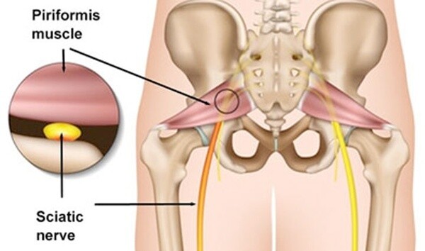 sciatica piriformis